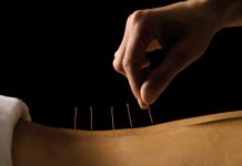 acupuncture needles on the back